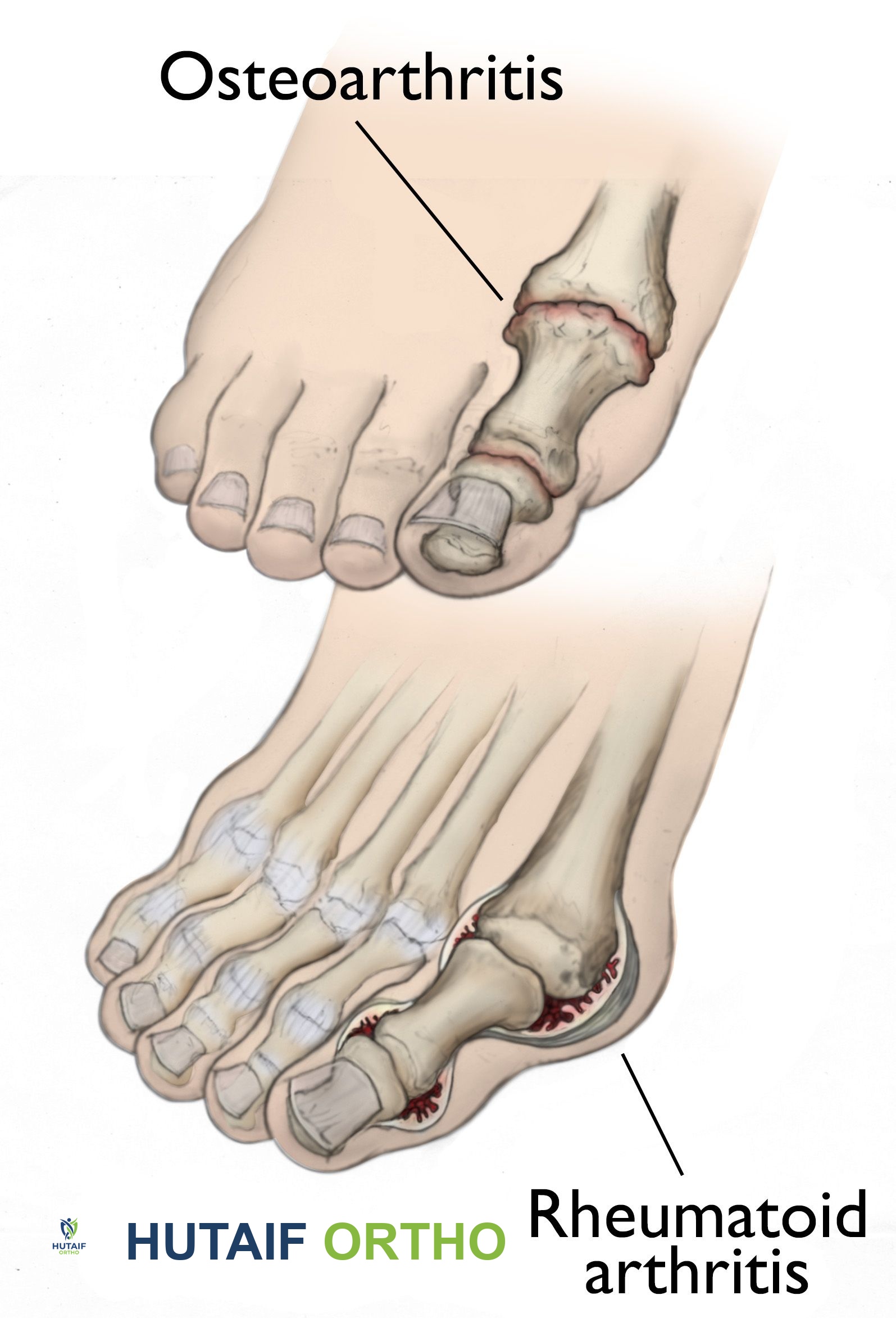صورة طبية: التهاب مفاصل القدم والكاحل: دليل شامل للتشخيص والعلاج مع الأستاذ الدكتور محمد هطيف