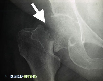 صورة توضيحية لـ كسور الورك: دليل الأستاذ الدكتور محمد هطيف الشامل للتشخيص والعلاج في صنعاء