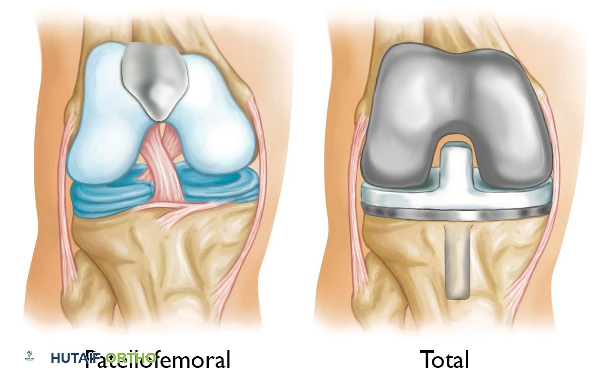 صورة طبية: التهاب مفصل الرضفة الفخذي: دليل شامل للعلاج والتعافي مع الأستاذ الدكتور محمد هطيف