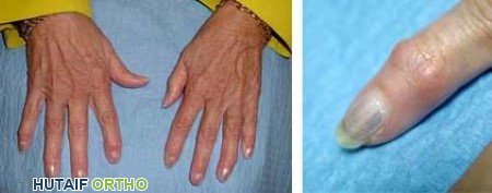 صورة توضيحية لـ خشونة المفاصل: دليل شامل للتشخيص والعلاج والتعافي مع الأستاذ الدكتور محمد هطيف