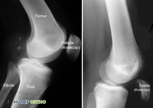 صورة بالأشعة السينية لتمزق الوتر الرباعي