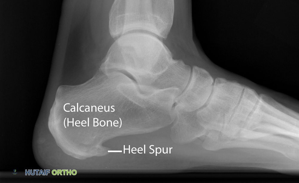 صورة طبية: التهاب اللفافة الأخمصية ونتوءات الكعب: دليل شامل لألم الكعب وعلاجه مع الأستاذ الدكتور محمد هطيف
