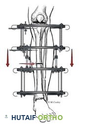 عدم التئام عظم الساق معالج بمثبت خارجي
