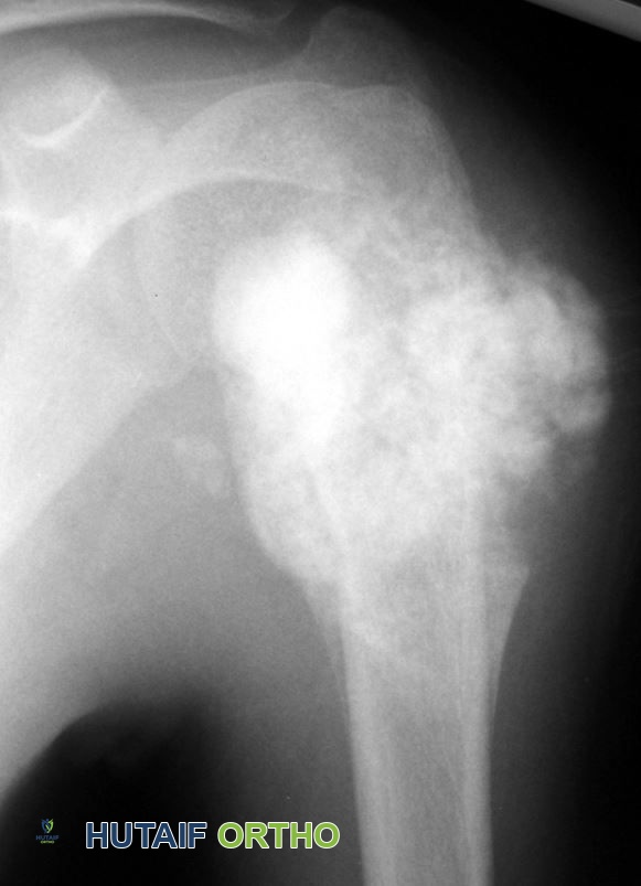صورة أشعة سينية لساركوما العظام في عظم العضد العلوي تظهر آفات سحابية الشكل