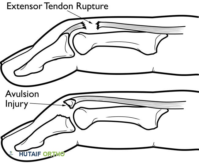 تمزق الوتر الباسط