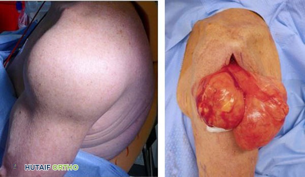 صور لورم شحمي في الكتف