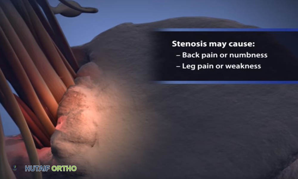 صورة طبية: الودانة (التقزم الغضروفي): دليل شامل للمرضى مع الأستاذ الدكتور محمد هطيف