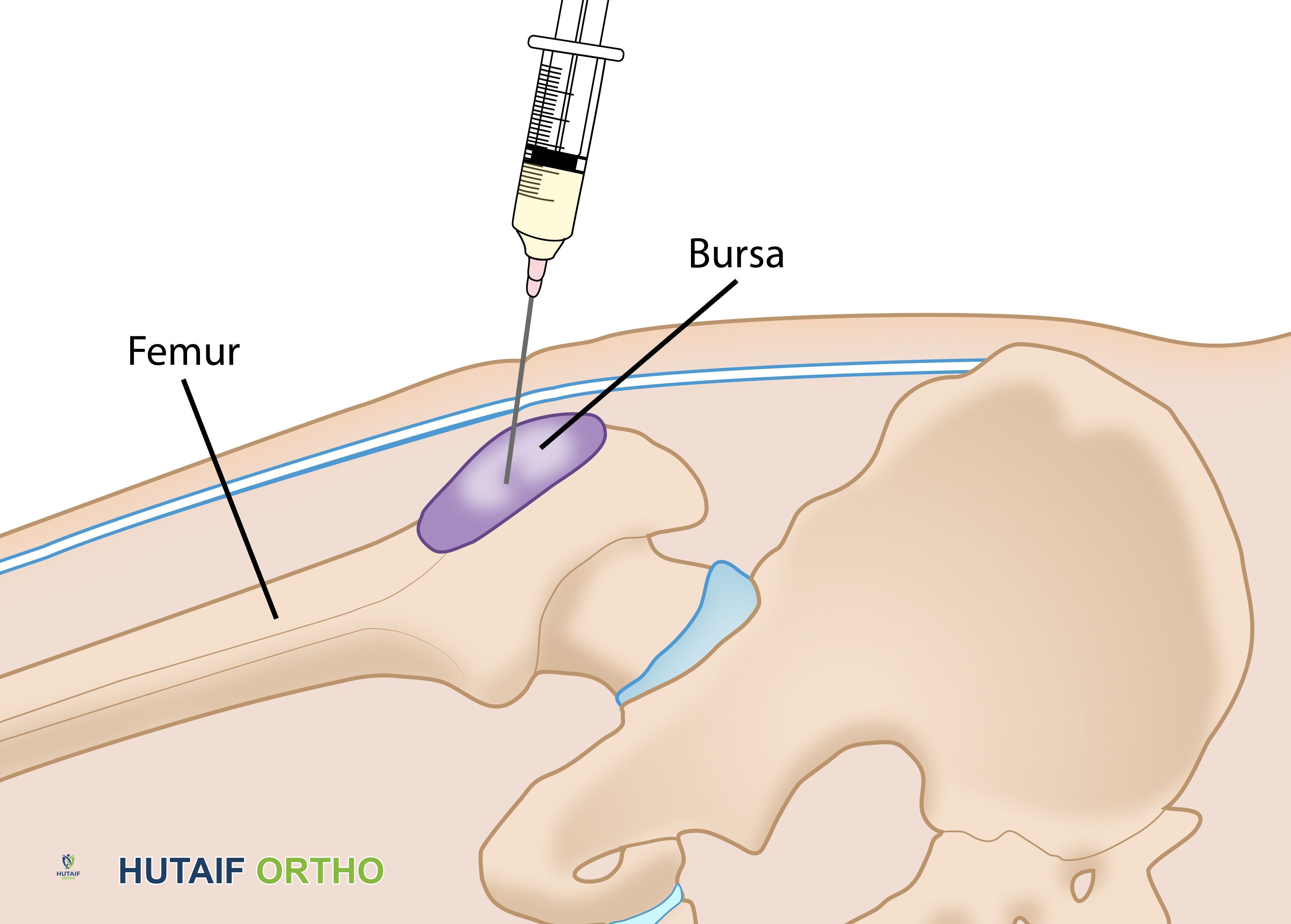 حقن الكورتيكوستيرويد
