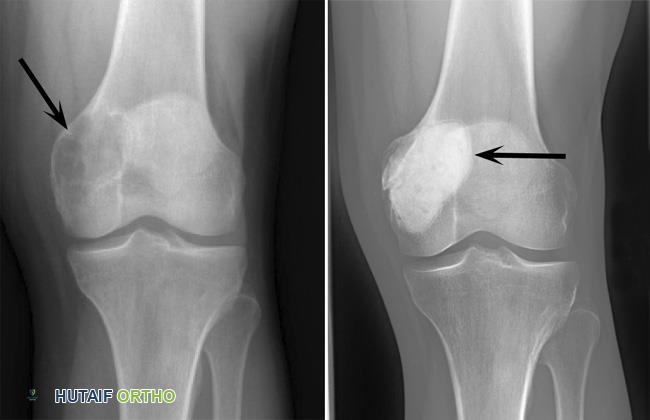توضيح طبي: ورم الخلايا العملاقة في العظم: دليل شامل للمرضى مع الأستاذ الدكتور محمد هطيف