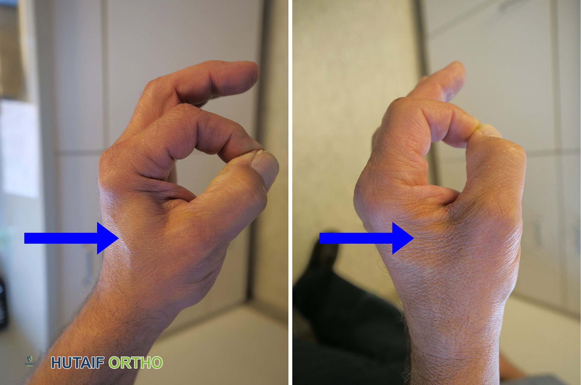 عضلات طبيعية وعضلات ضامرة