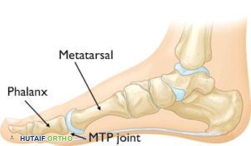 صورة توضيحية لـ إصابة إصبع القدم العشبية (Turf Toe): دليل شامل للمرضى مع الأستاذ الدكتور محمد هطيف