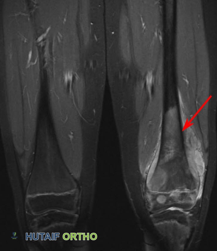 صورة رنين مغناطيسي لساركوما العظام في عظم الفخذ الأيسر السفلي لمريض يبلغ من العمر 10 سنوات