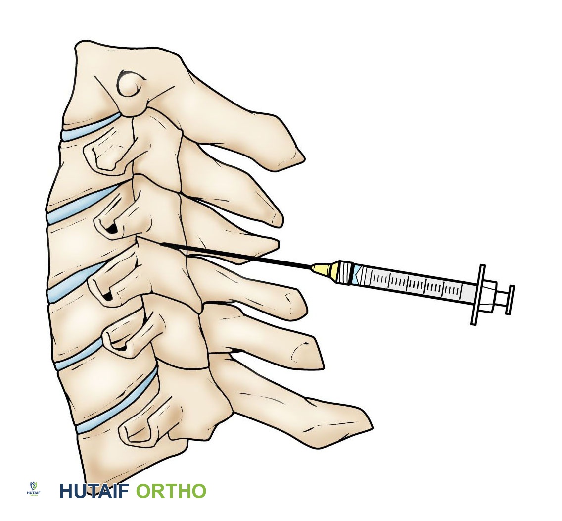 صورة طبية: الاعتلال الجذري العنقي (انضغاط العصب في الرقبة): دليل شامل من الأستاذ الدكتور محمد هطيف