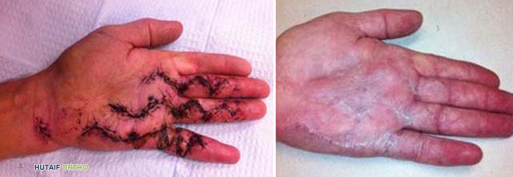 صورة توضيحية لـ مرض دوبويتران: دليل شامل للتشخيص والعلاج مع الأستاذ الدكتور محمد هطيف في صنعاء