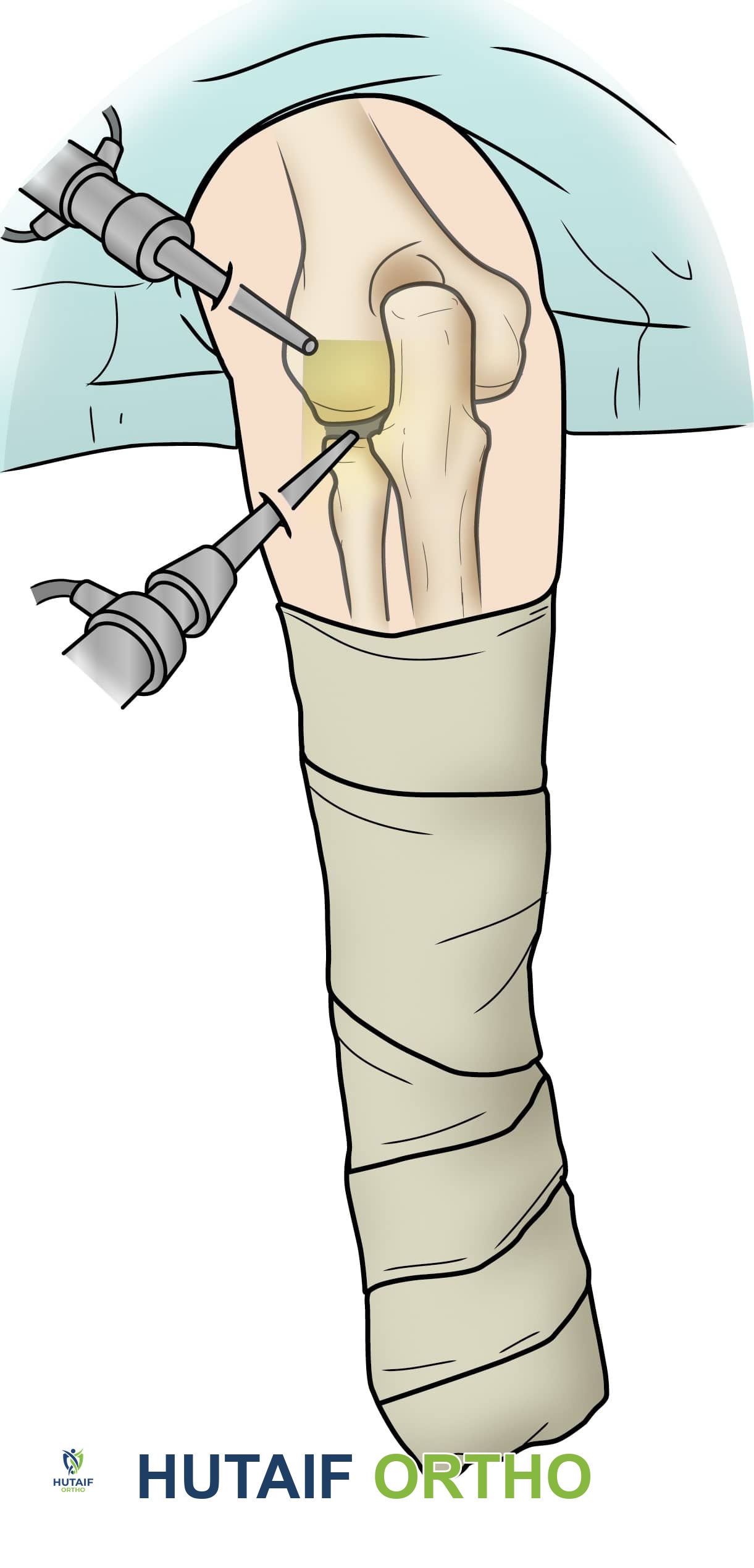 صورة توضيحية لـ خشونة مفصل الكوع: الأسباب، الأعراض، التشخيص، وخيارات العلاج المتقدمة في صنعاء مع الأستاذ الدكتور محمد هطيف