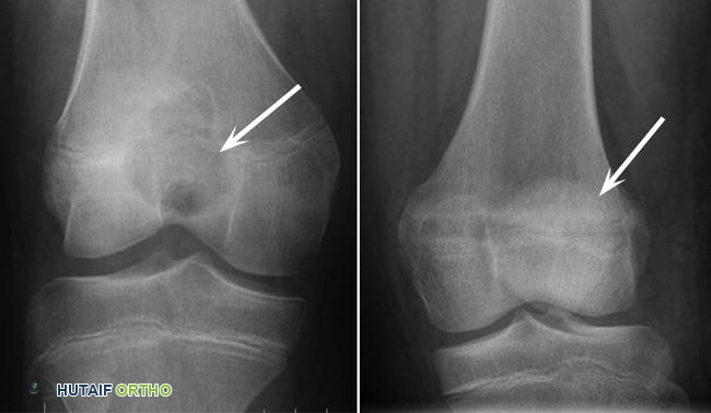 تُظهر (يسار) الأشعة السينية قبل الجراحة ورمًا أروميًا غضروفيًا في الطرف السفلي لعظم الفخذ. (يمين) تُظهر الأشعة السينية الورم بعد العلاج بالكشط وحشو التجويف بالأسمنت العظمي.