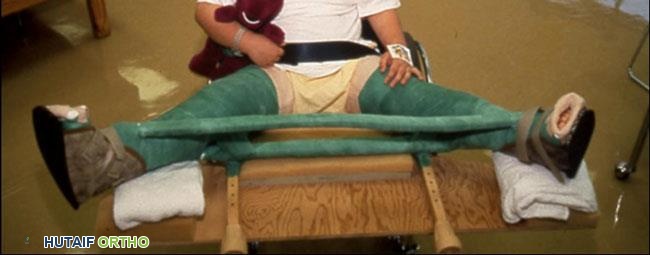 صورة طبية: مرض بيرثيز عند الأطفال: دليل شامل للآباء والعلاج المتطور في صنعاء مع الأستاذ الدكتور محمد هطيف