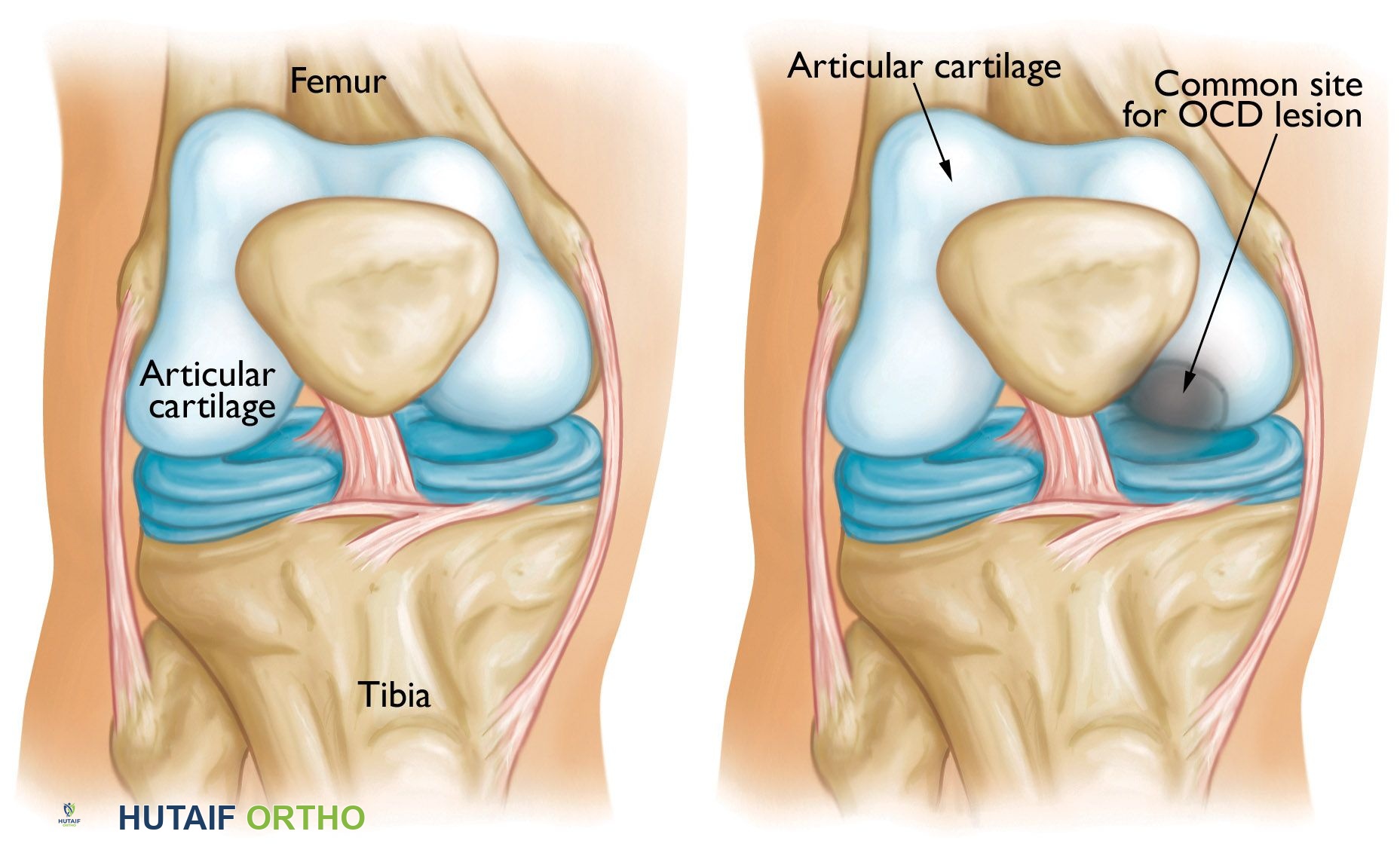 التهاب العظم والغضروف السالخ في الركبة