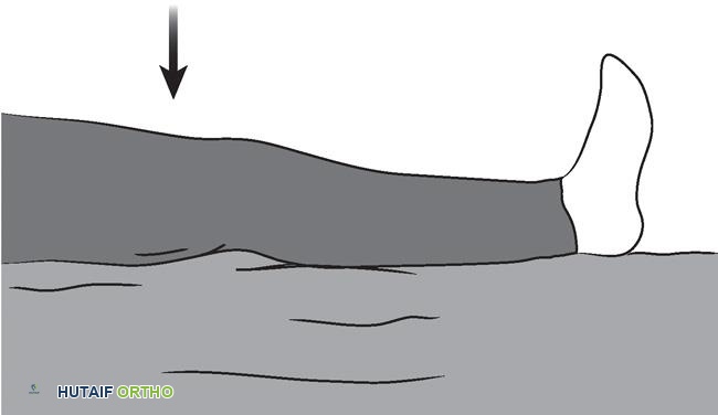 توضيح طبي: دليل تمارين استبدال مفصل الورك الكلي: رحلتك نحو التعافي الكامل مع الأستاذ الدكتور محمد هطيف