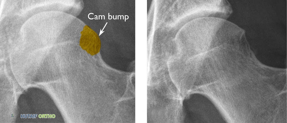 صورة توضيحية لـ الاحتكاك الفخذي الحُقّي (FAI): دليل شامل من الأستاذ الدكتور محمد هطيف