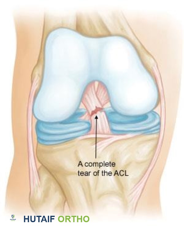 تمزق كامل في الرباط الصليبي الأمامي، يوضح فقدان الاستمرارية وتلف البنية الرباطية الطبيعية.