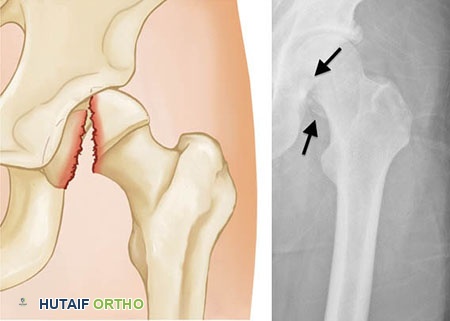 صورة طبية: كسور الورك: دليل الأستاذ الدكتور محمد هطيف الشامل للتشخيص والعلاج في صنعاء