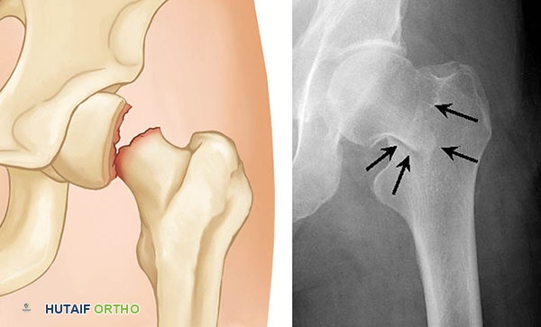 صورة طبية: كسور الورك: دليل الأستاذ الدكتور محمد هطيف الشامل للتشخيص والعلاج في صنعاء
