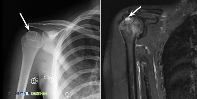 تُظهر (يسار) الأشعة السينية ورمًا أروميًا غضروفيًا في الطرف العلوي لعظم العضد. لاحظ الحواف البيضاء التي تحدد الورم. (يمين) صورة بالرنين المغناطيسي لنفس الورم.