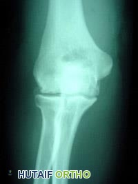 صورة توضيحية لـ خشونة مفصل الكوع: الأسباب، الأعراض، التشخيص، وخيارات العلاج المتقدمة في صنعاء مع الأستاذ الدكتور محمد هطيف