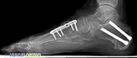 صورة توضيحية لـ القدم المسطحة المكتسبة لدى البالغين تشوه القدم الانبطاحي التدريجي