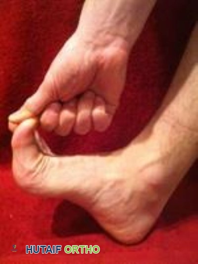 صورة طبية: إصابة إصبع القدم العشبية (Turf Toe): دليل شامل للمرضى مع الأستاذ الدكتور محمد هطيف