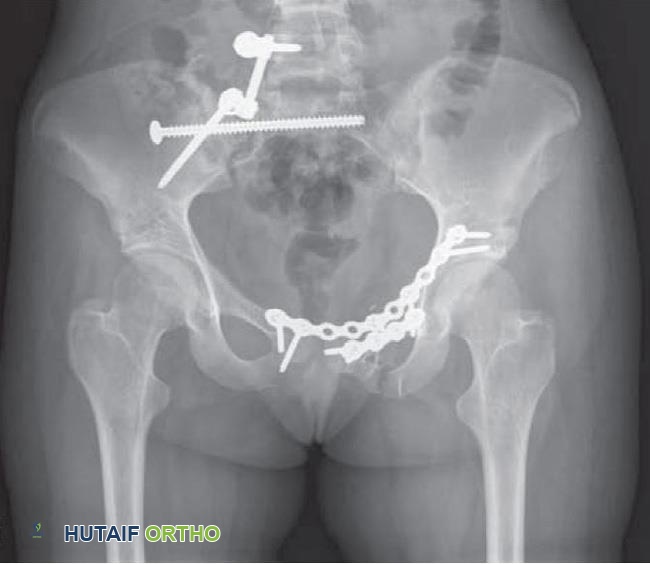 صورة توضيحية لـ كسور الحوض: دليل شامل للمرضى مع الأستاذ الدكتور محمد هطيف في صنعاء