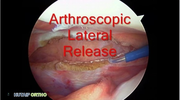 صورة توضيحية لـ متلازمة ألم الرضفة الفخذية ركبة العدّاء الأسباب التشخيص العلاج والتعافي مع الدكتور محمد هطيف في صنعاء