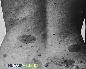 مريض بالورم الليفي العصبي من النوع الأول (NF1)