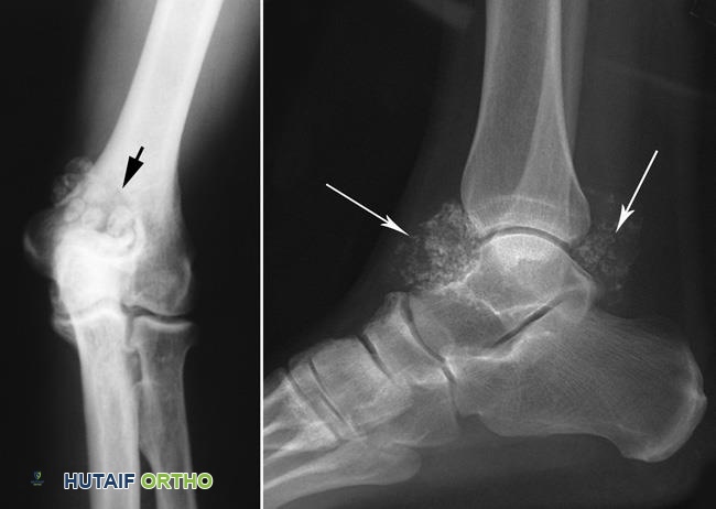 صور أشعة سينية للورم الغضروفي الزليلي في الكوع والكاحل