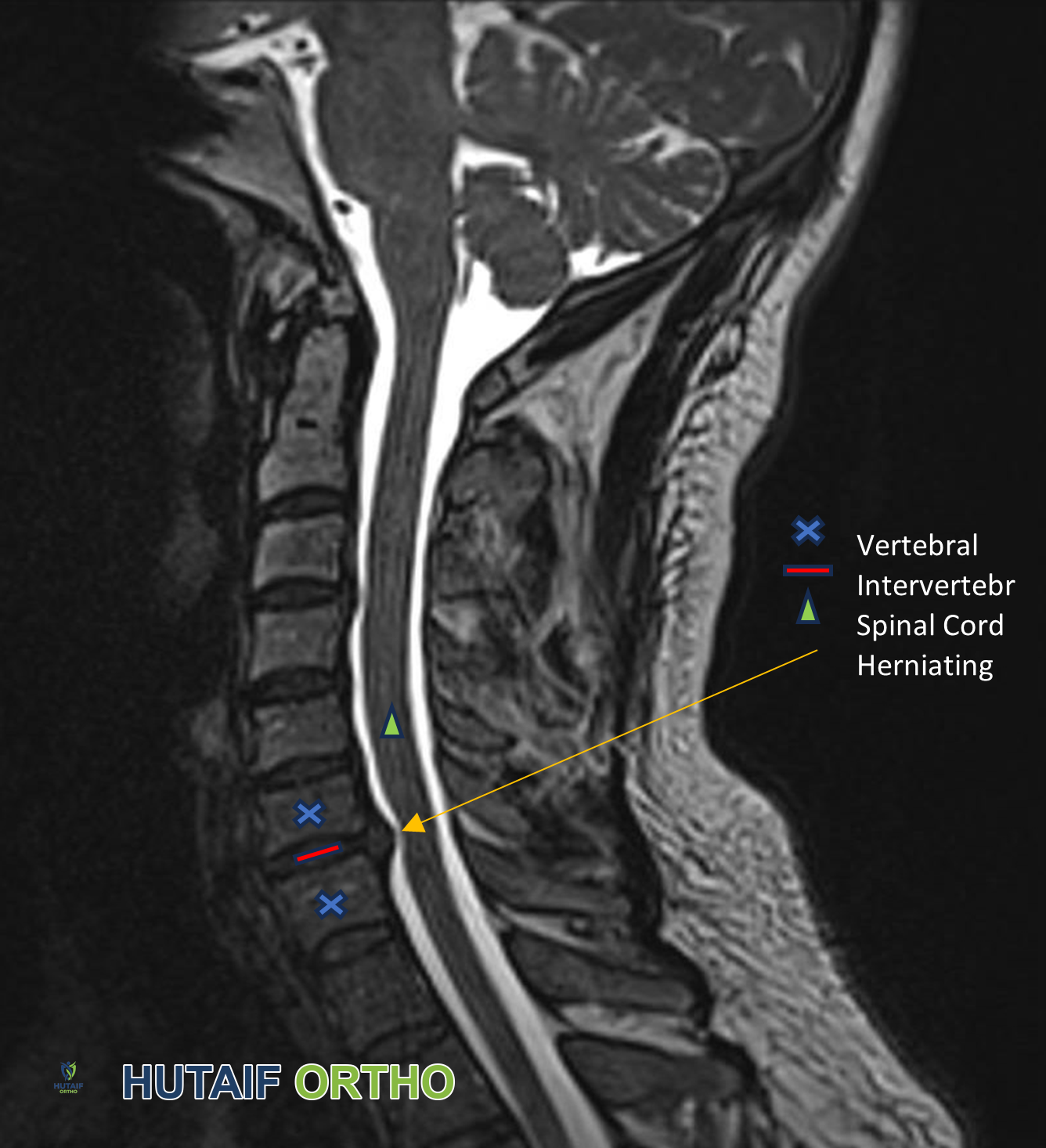 صورة طبية: الاعتلال الجذري العنقي (انضغاط العصب في الرقبة): دليل شامل من الأستاذ الدكتور محمد هطيف