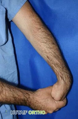 صورة توضيحية لـ مرفق التنس (التهاب اللقيمة الوحشية): دليل شامل من الأستاذ الدكتور محمد هطيف