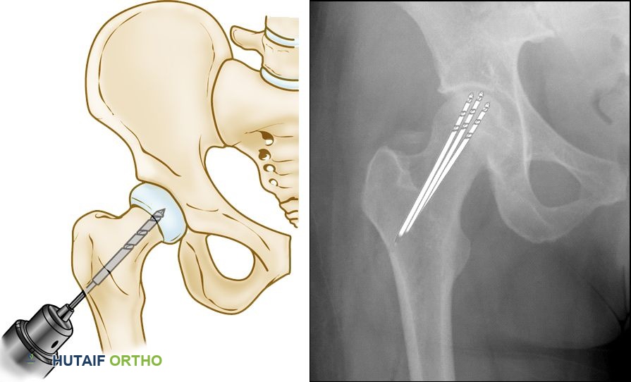 صورة توضيحية لـ النخر العظمي في مفصل الورك: دليل شامل للمرضى مع الأستاذ الدكتور محمد هطيف