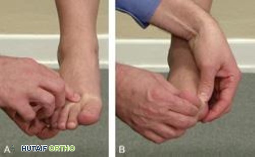 صورة توضيحية لـ إصابة إصبع القدم العشبية (Turf Toe): دليل شامل للمرضى مع الأستاذ الدكتور محمد هطيف