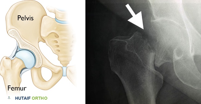 الوقاية من كسور الورك: دليلك الشامل للحفاظ على صحة عظامك مع الأستاذ الدكتور محمد هطيف