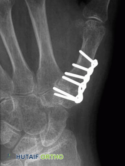 صورة توضيحية لـ خشونة إبهام اليد: دليل شامل للمرضى من الأستاذ الدكتور محمد هطيف