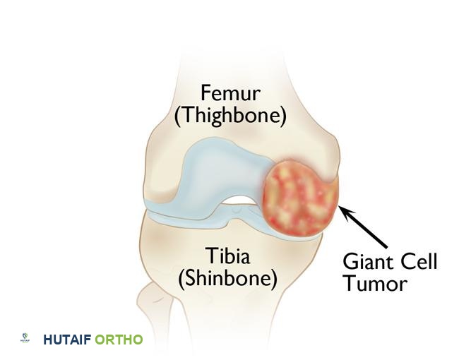 توضيح طبي: ورم الخلايا العملاقة في العظم: دليل شامل للمرضى مع الأستاذ الدكتور محمد هطيف