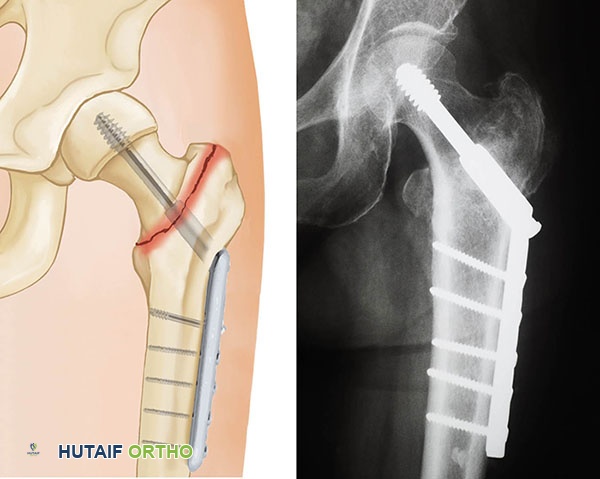 صورة طبية: كسور الورك: دليل الأستاذ الدكتور محمد هطيف الشامل للتشخيص والعلاج في صنعاء