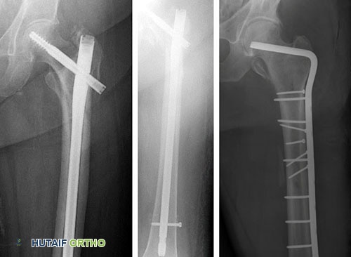 صورة طبية: كسور الورك: دليل الأستاذ الدكتور محمد هطيف الشامل للتشخيص والعلاج في صنعاء