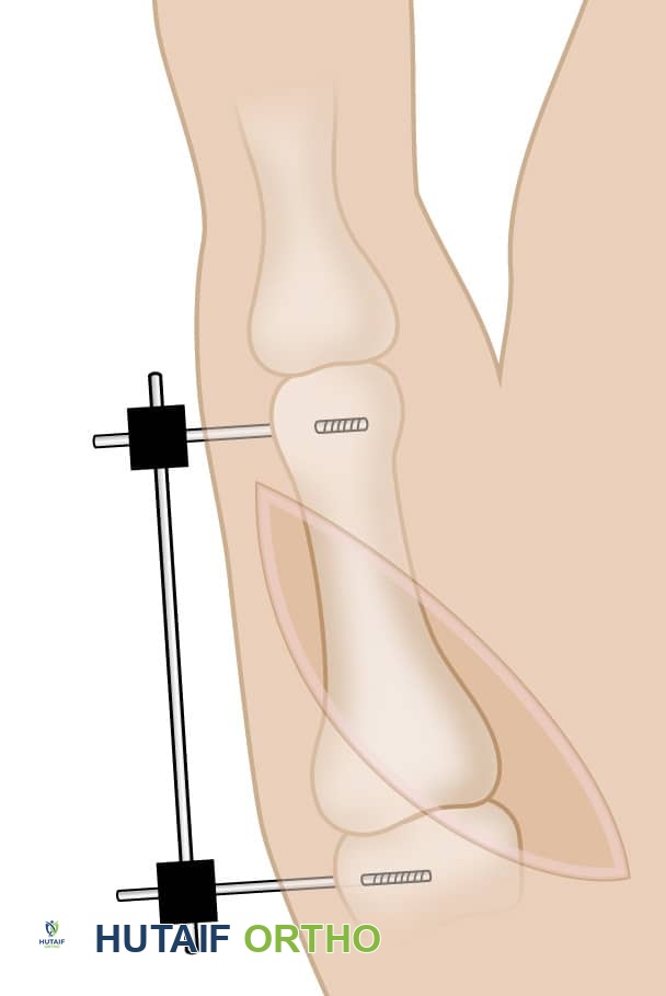 صورة توضيحية لـ كسور الإبهام: دليل شامل للتشخيص والعلاج والتعافي مع الأستاذ الدكتور محمد هطيف في صنعاء