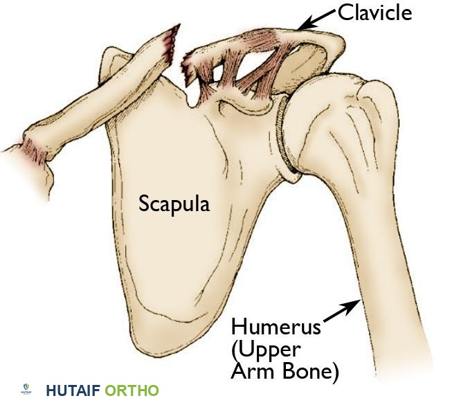 يوضح هذا الرسم التوضيحي كسرًا في الترقوة الجانبية، وهو موقع شائع يتأثر بالارتباطات الرباطية والعضلية المعقدة في المنطقة.