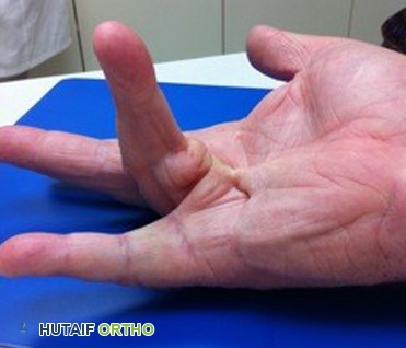 مرض دوبويتران: دليل شامل للتشخيص والعلاج مع الأستاذ الدكتور محمد هطيف في صنعاء