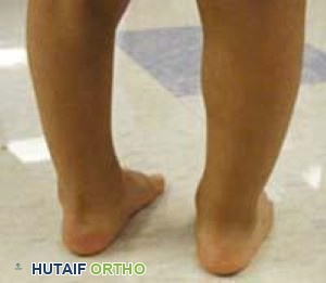 طفل بعد العلاج بطريقة بونستي للقدم الحنفاء