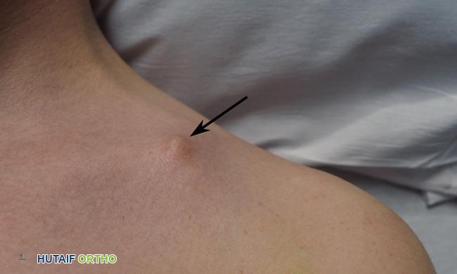 صورة توضيحية لـ كسر الترقوة (عظم الترقوة المكسور): دليل شامل للمرضى مع الأستاذ الدكتور محمد هطيف