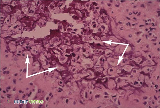 شريحة باثولوجية لورم أرومي غضروفي